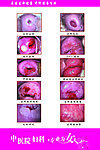 妇科展板