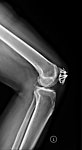 X线照片 膝关节