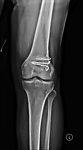 X线照片膝关节