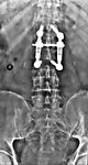 X线照片腰椎