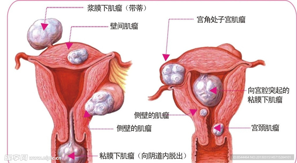 子宫肌瘤