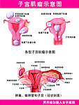 子宫肌瘤挂图