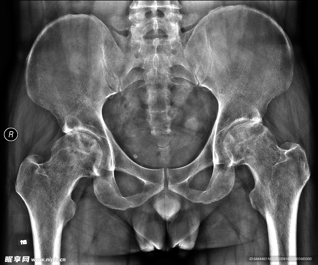 X线拍片骨盆