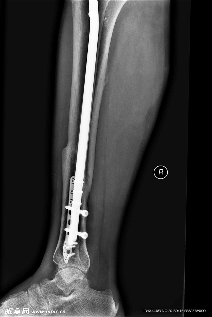 X线拍片踝关节