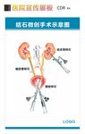 结石手术示意图