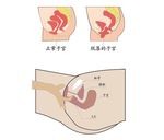 子宫脱垂矢量图