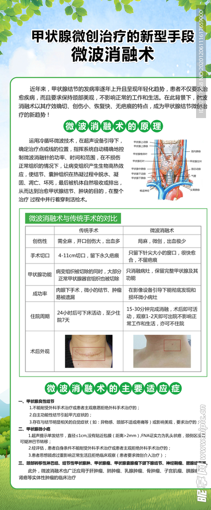 甲状腺微波消融术