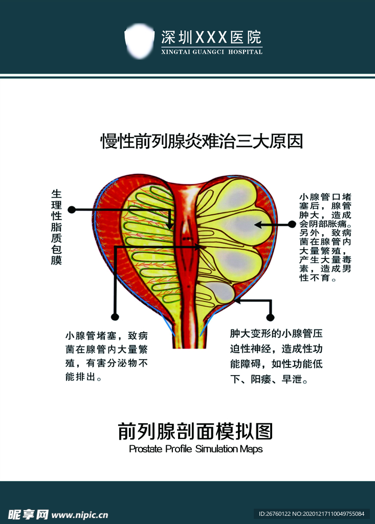 前列腺剖面模拟图