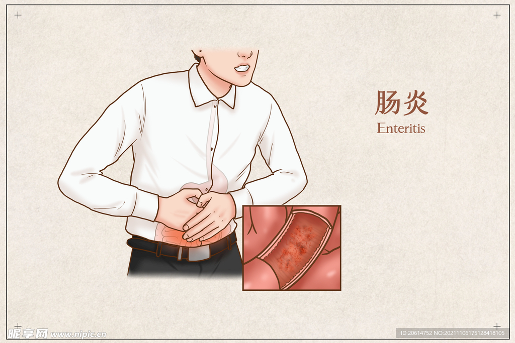 肠炎