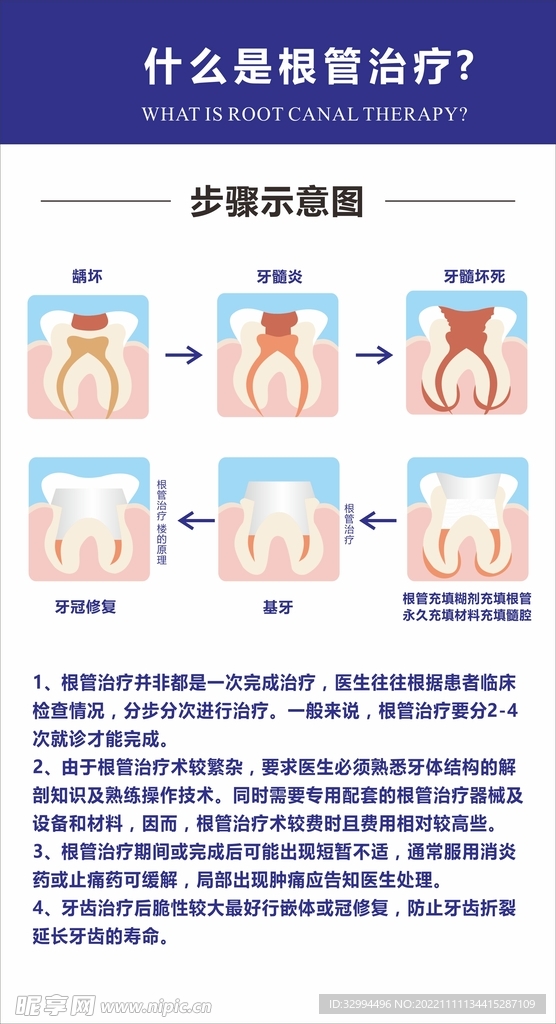 根管治疗