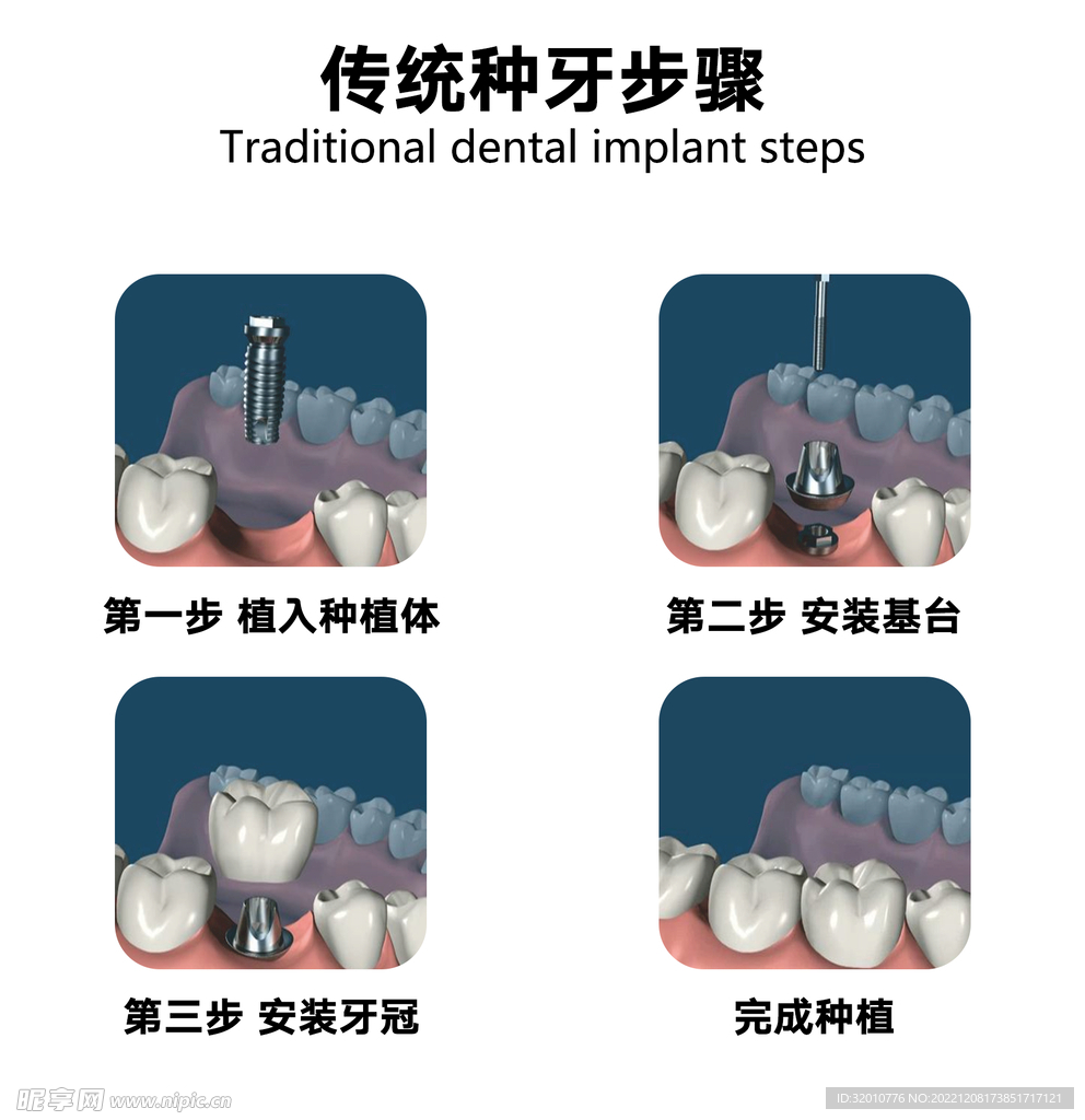 种植牙过程