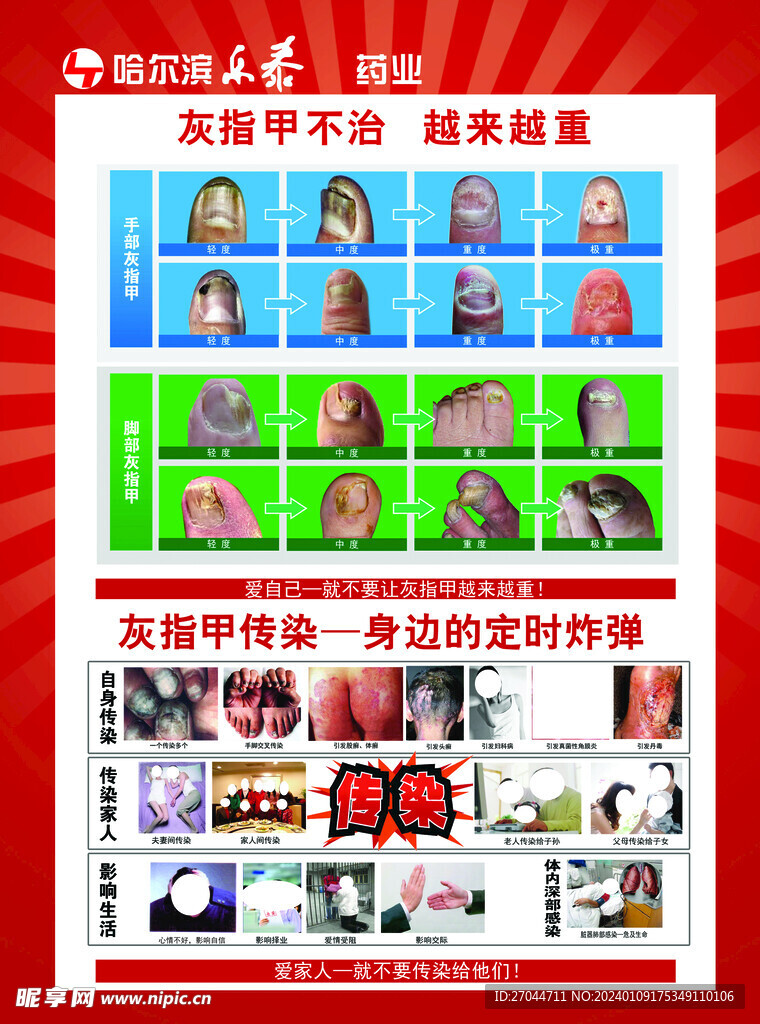 治療灰指甲