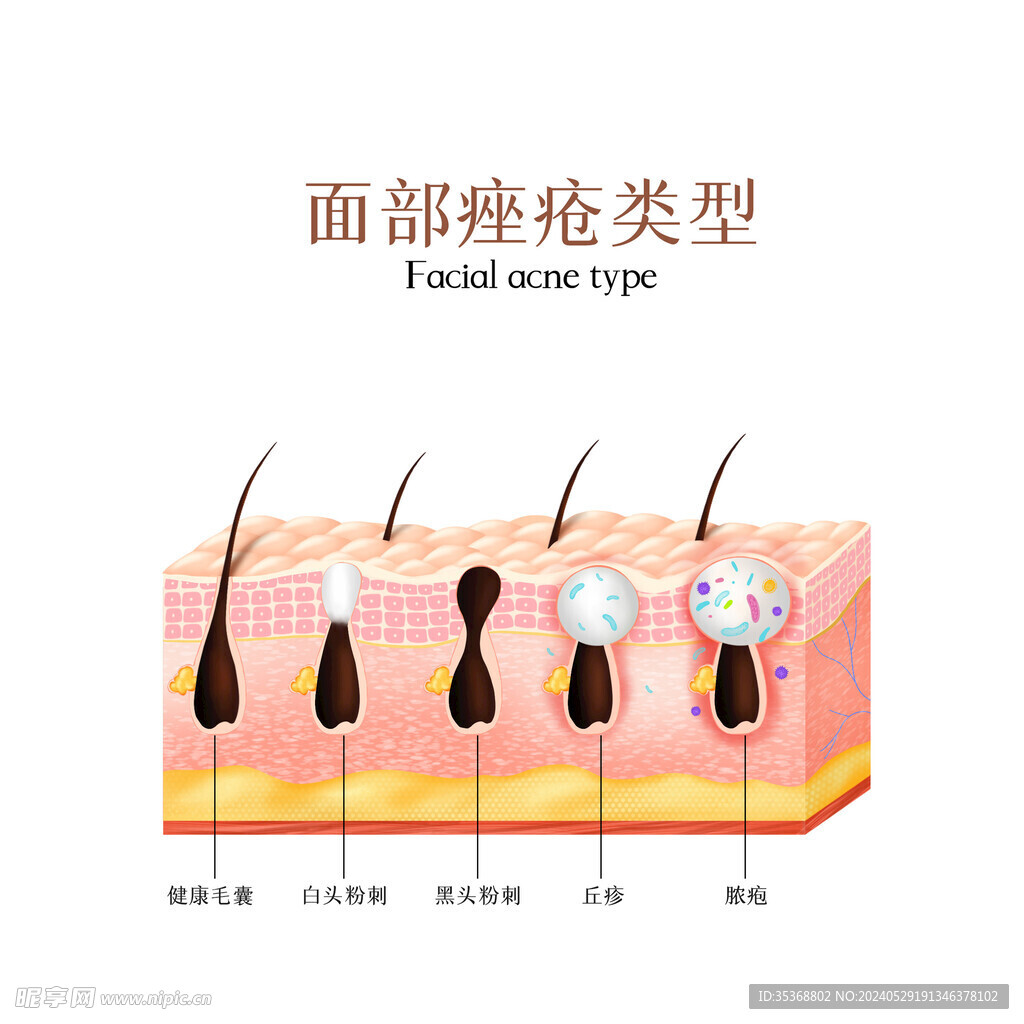 面部痤瘡