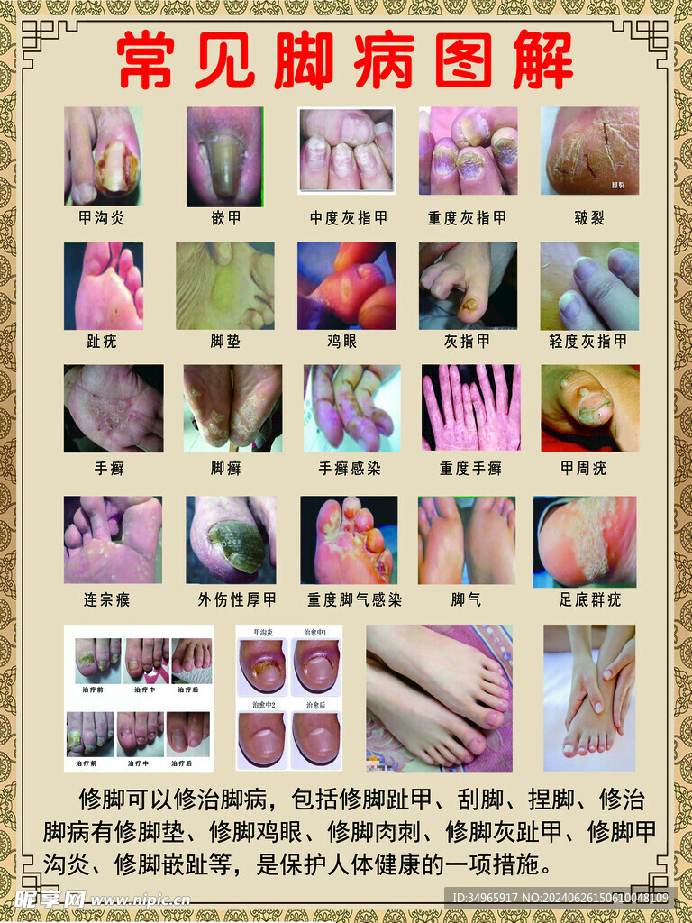 腳病腳氣圖解