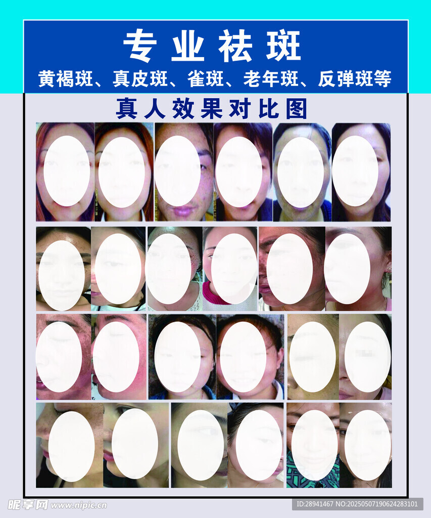 專業祛斑