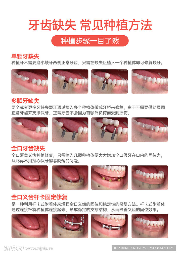 口腔牙科常見種植方式海報