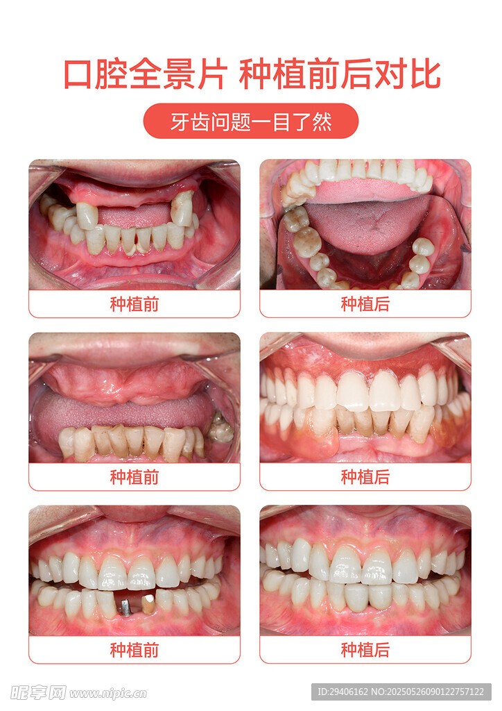 口腔牙科種植牙前后對比案例