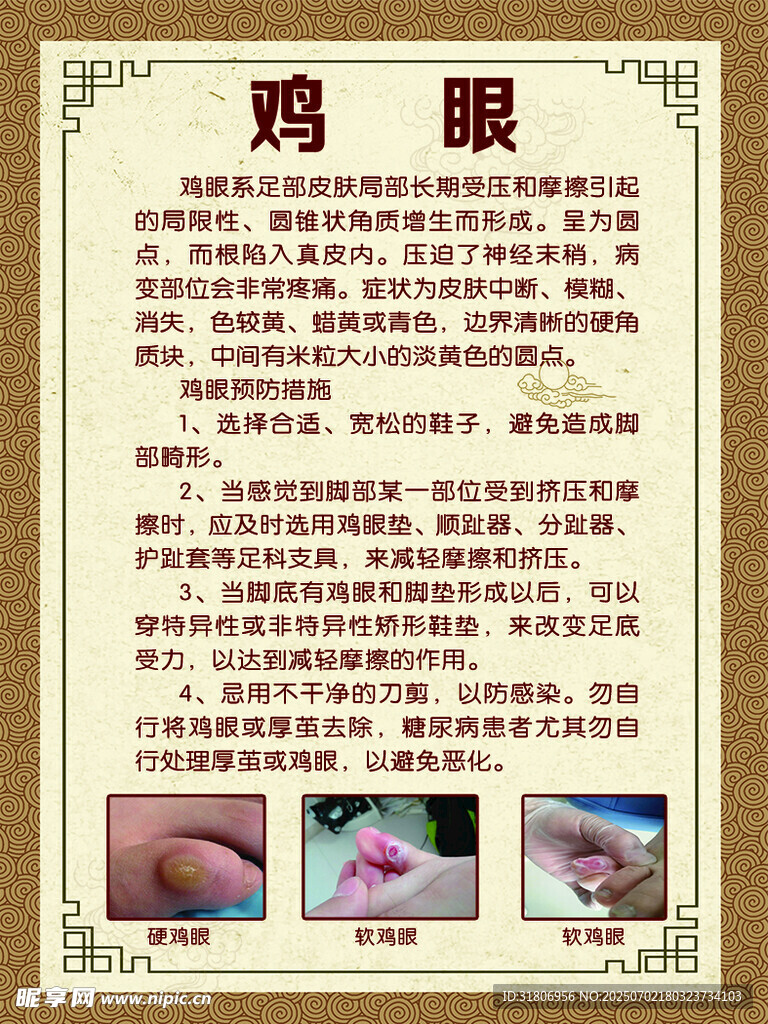 雞眼知識(shí)科普與處理圖示