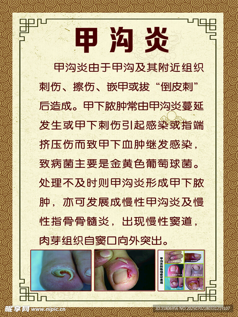 甲溝炎科普介紹