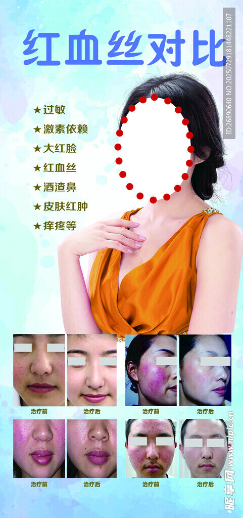 面部紅血絲對(duì)比效果圖