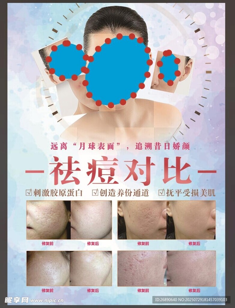 祛痘前后對比展示圖