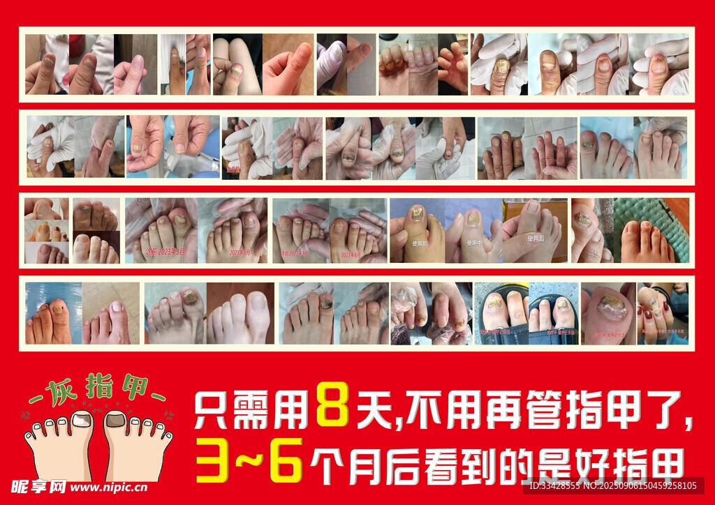 灰指甲
