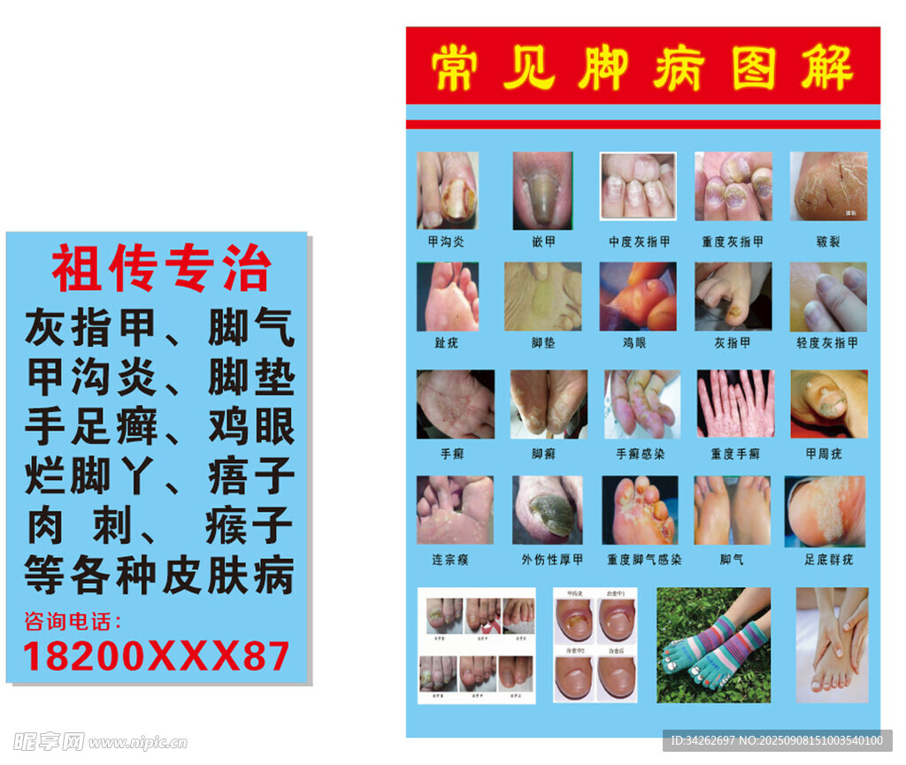 灰指甲常見(jiàn)腳病圖解