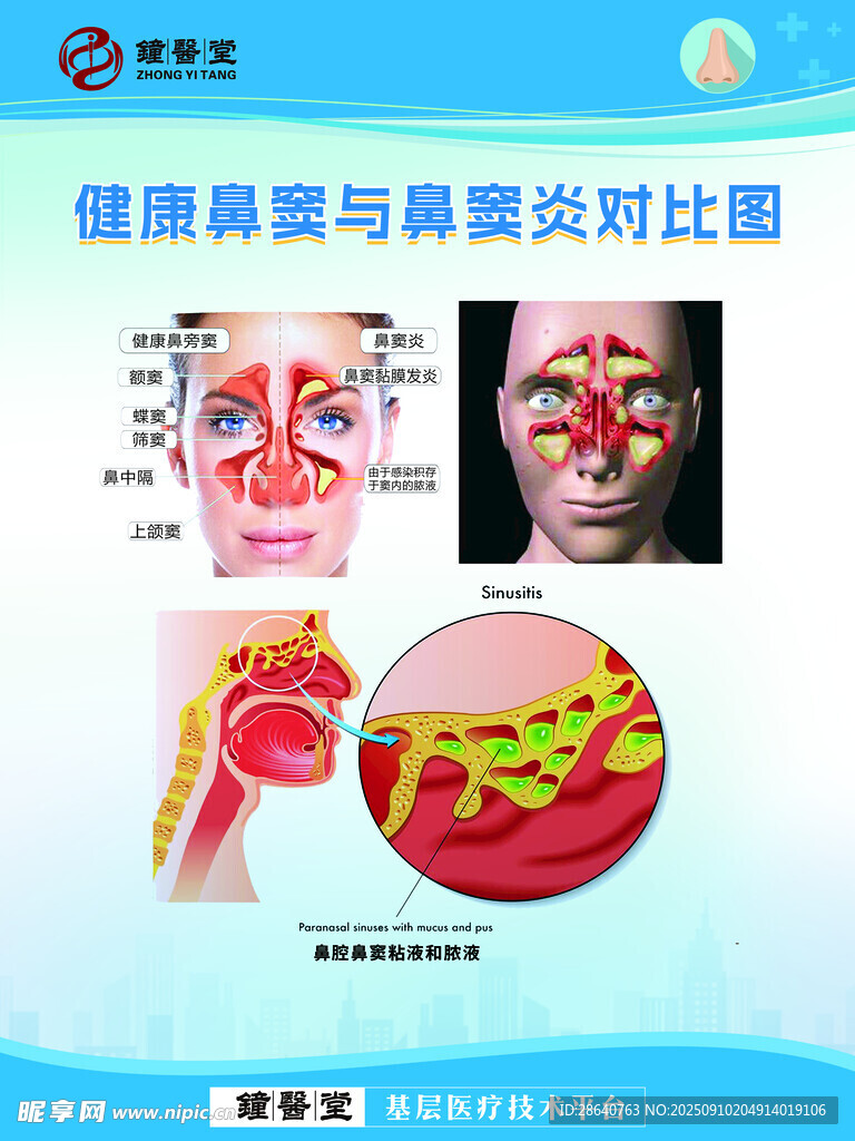 健康鼻竇與鼻竇炎癥對比圖