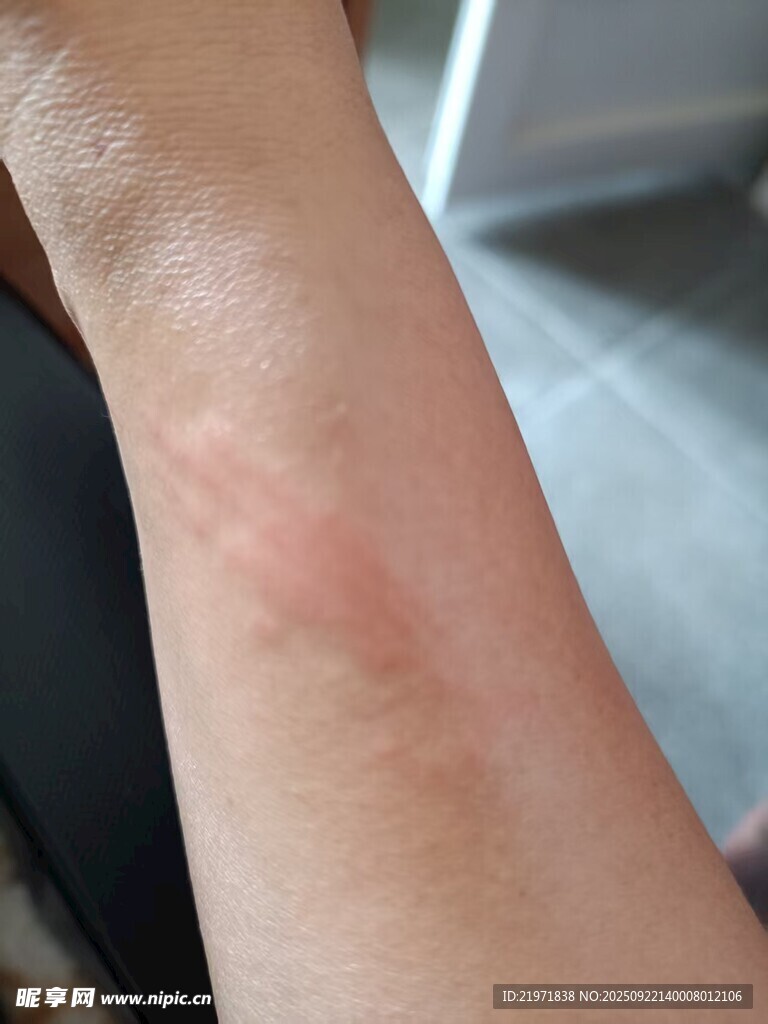手臂上的紅斑皮膚狀況