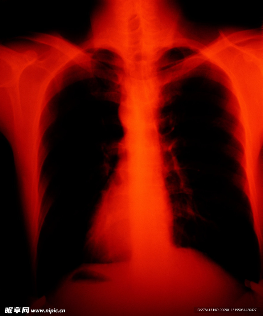胸腔  X光