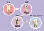 龋齿形成图解