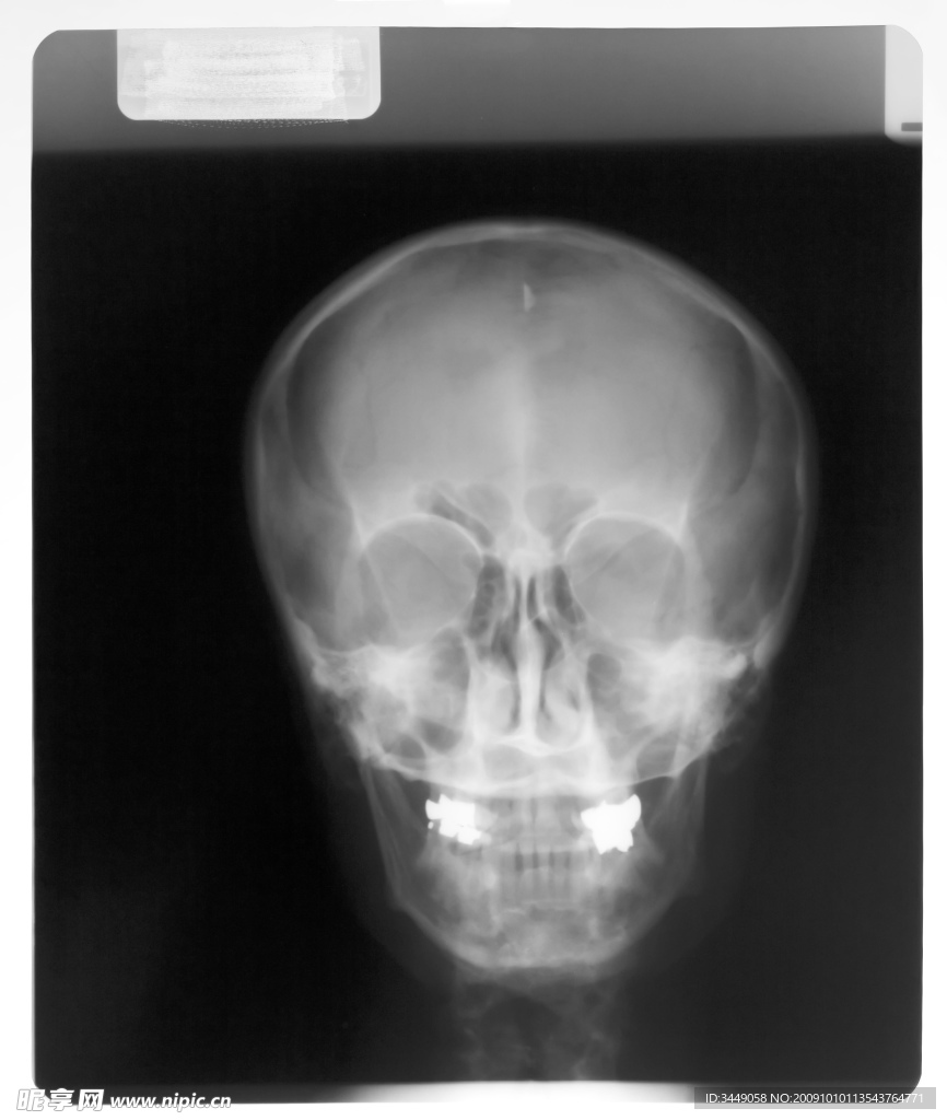 头部X光片