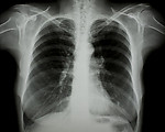胸部X光片