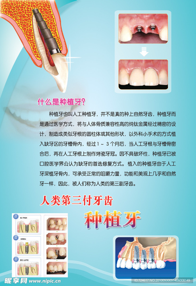 口腔科种植