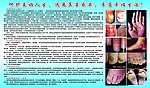 手足癣