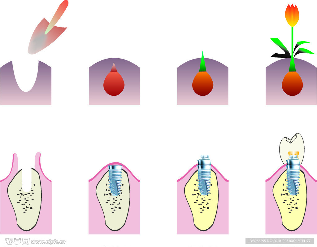 种植牙流程图
