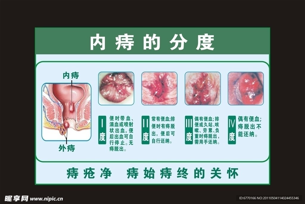 内痔分度