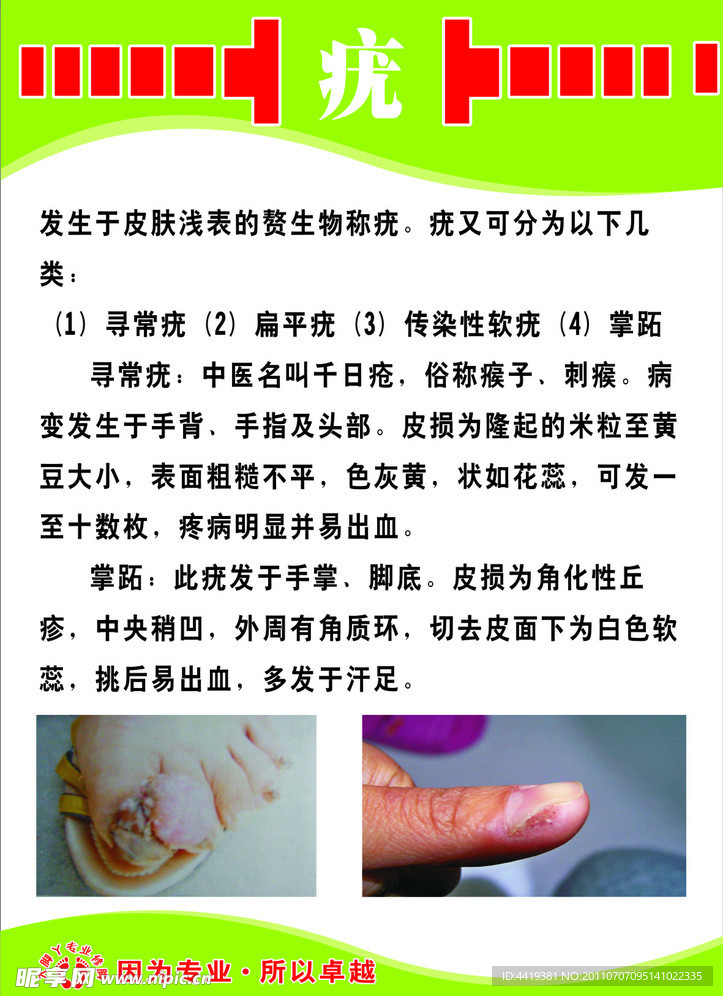 瘊子