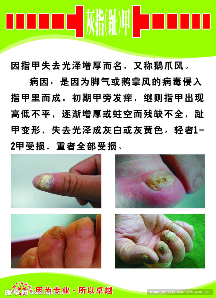 灰指甲