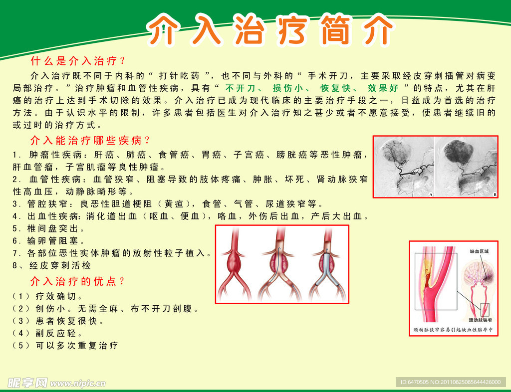 介入治疗简介展板