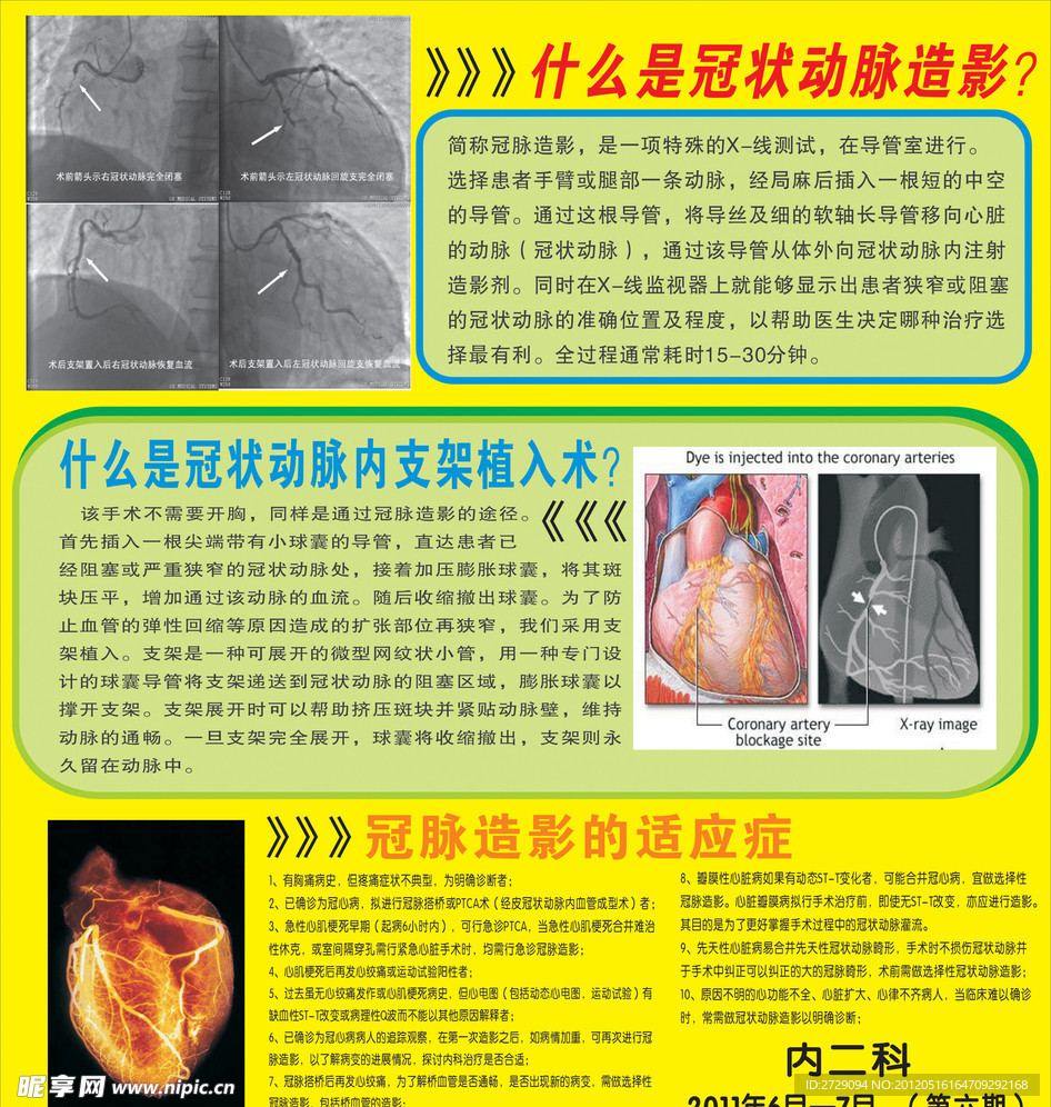 冠状动脉造影