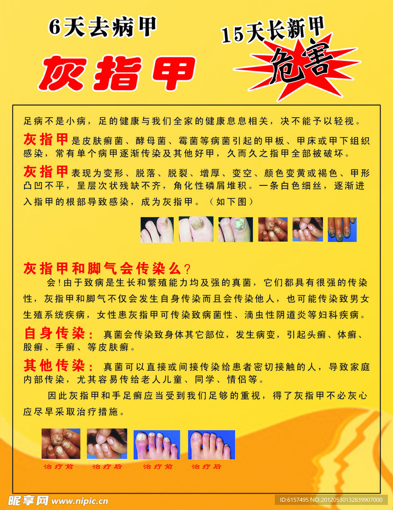 灰指甲图