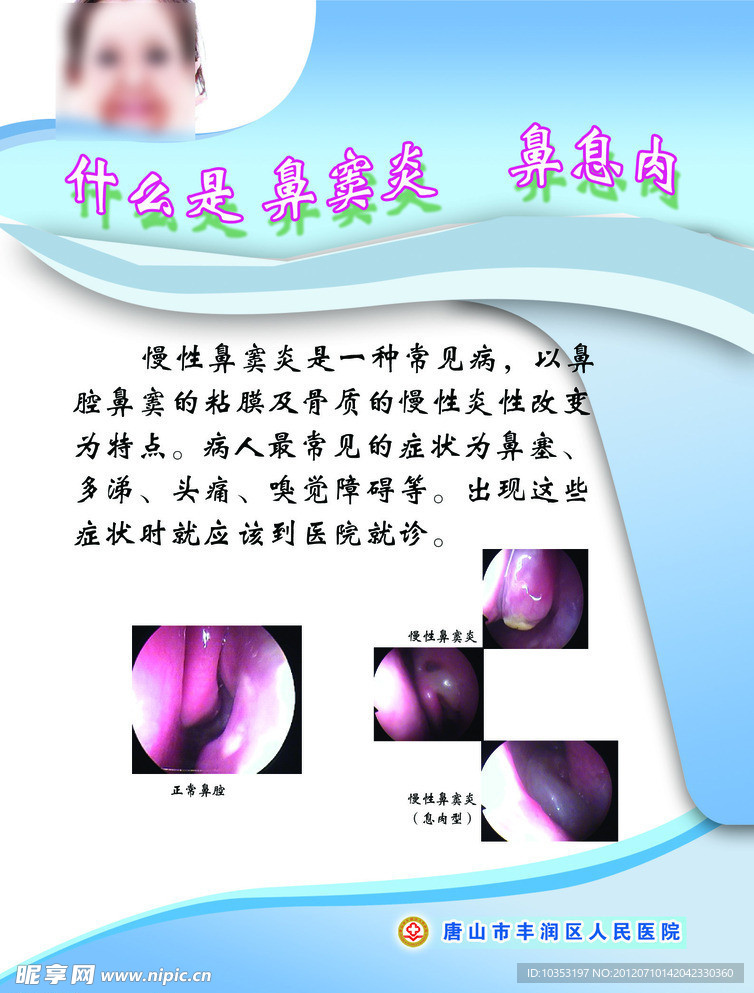 鼻窦炎