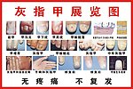 灰指甲