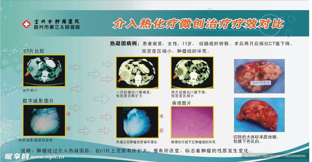 介入热化疗疗效