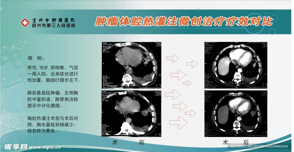 体腔热灌注疗效