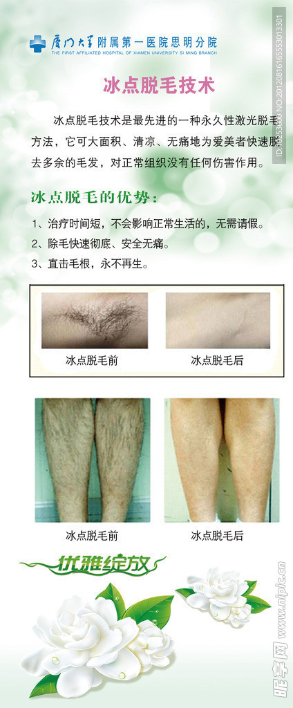 冰点脱毛