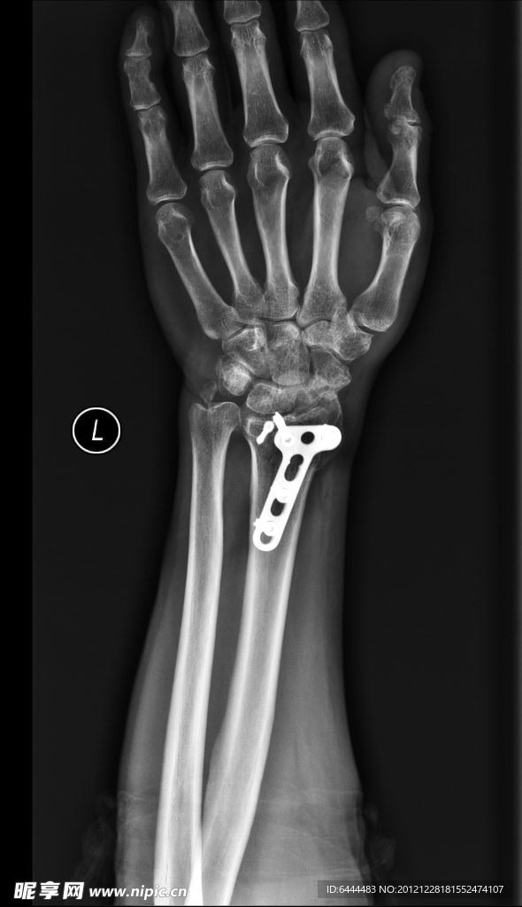 X线照片腕关节