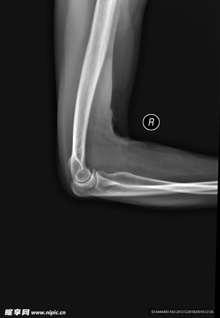 X线照片肘关节