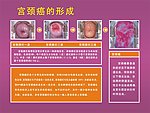 宫颈图
